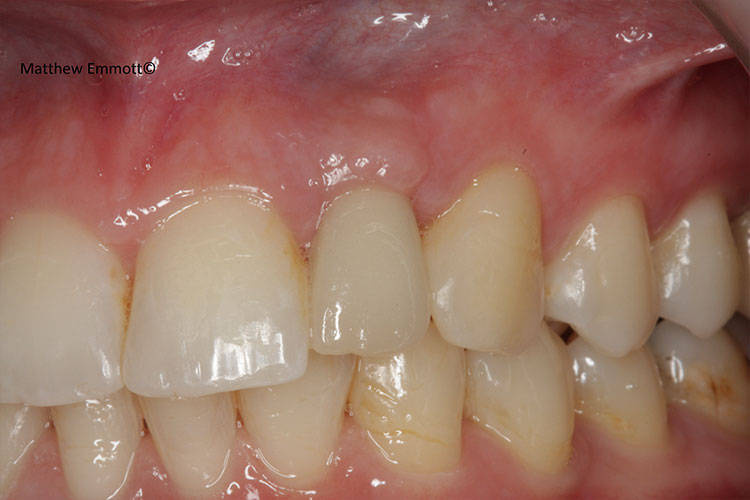 After implant