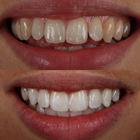 Tooth Whitening System